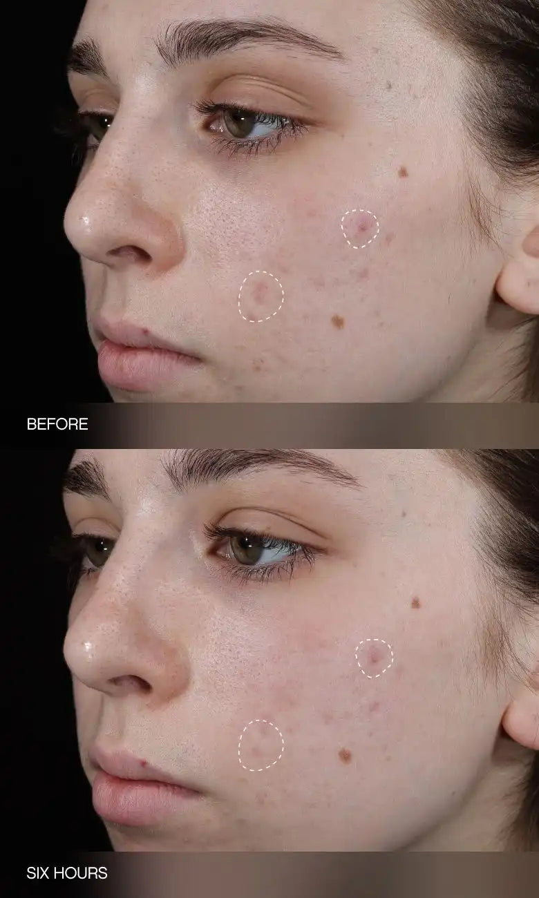 Faded Dark Spot Patches