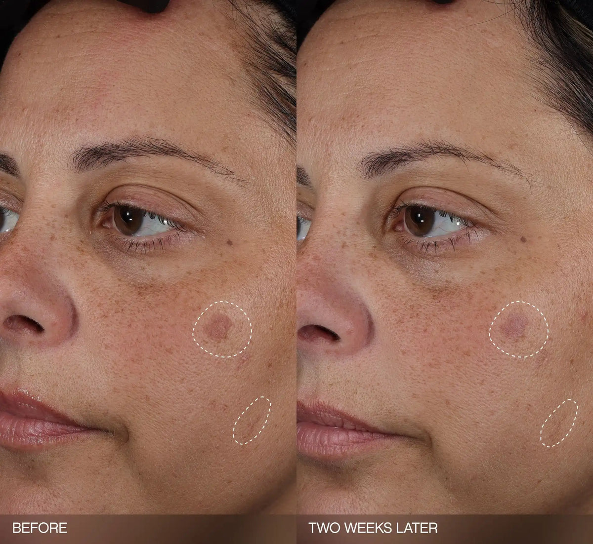 Faded Dark Spot Patches