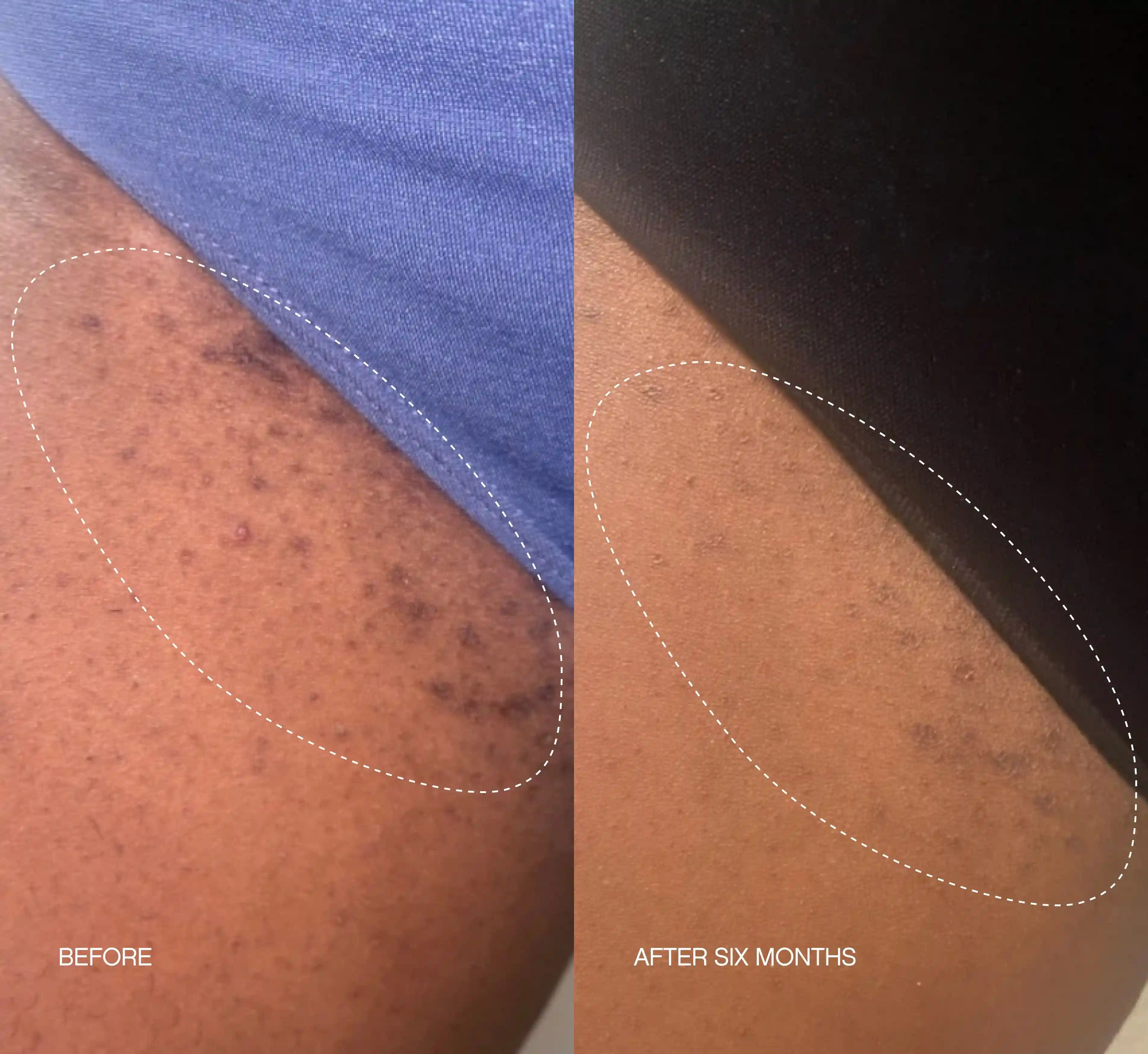 Ingrown Duo Secondary image
