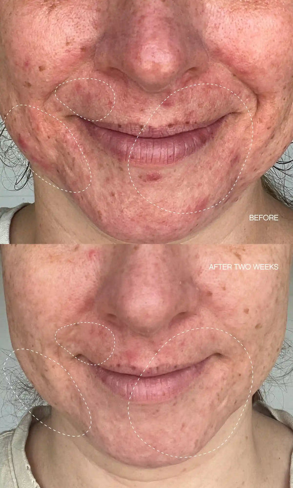 Clearly Blemish Mask