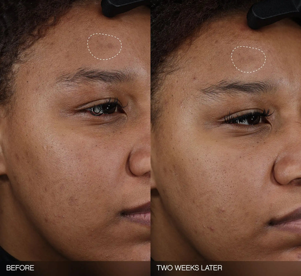 Faded Dark Spot Patches