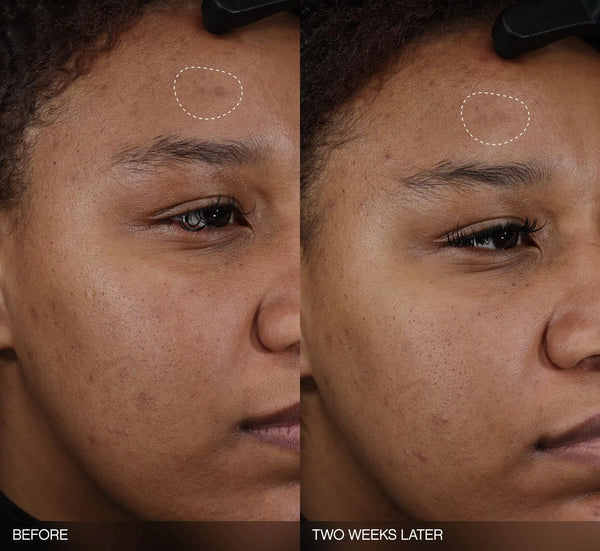 Faded Dark Spot Patches
